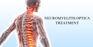 Unlock the Path to Neurological Relief with Leading Specialist Doctor for Neuromyelitis Optica in Hyderabad. Experience Personalized Care for a Brighter Tomorrow.