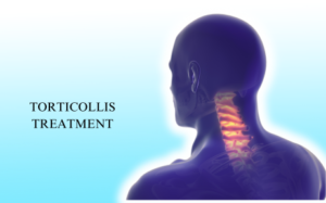 Looking for Torticollis Treatment in Hyderabad? Experience Tailored Care and Management for Lasting Relief at Dr. Sriram Neuro. Book Consultation Today!  